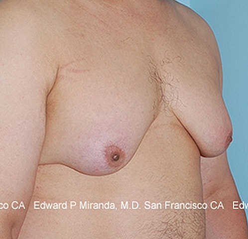 Gynecomastia Before & After