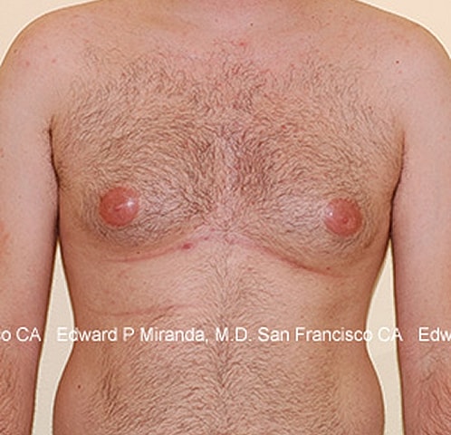 Gynecomastia Before & After