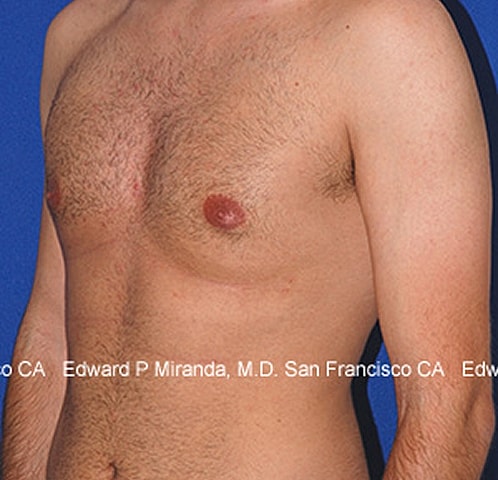 Gynecomastia Before & After