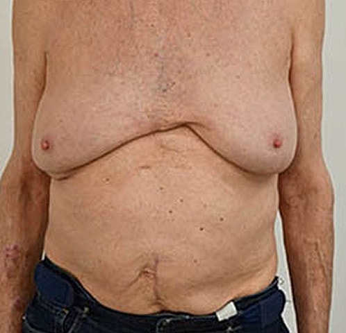 Gynecomastia Before & After