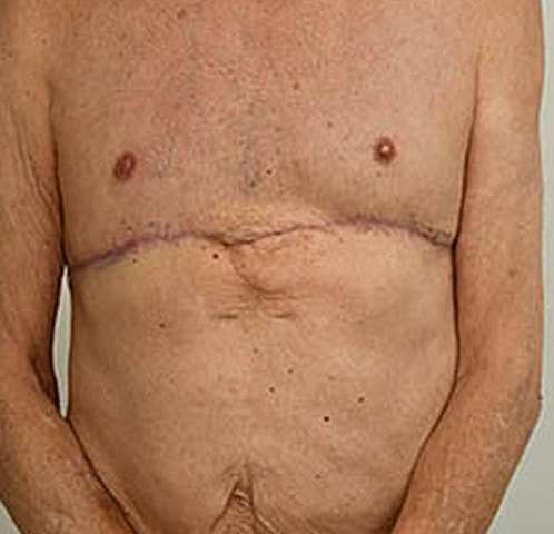 Gynecomastia Before & After
