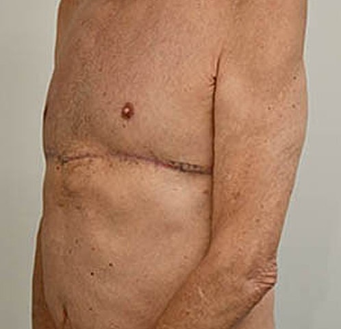 Gynecomastia Before & After