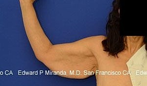 Arm Lift Before & After