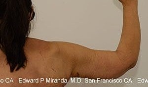 Arm Lift Before & After