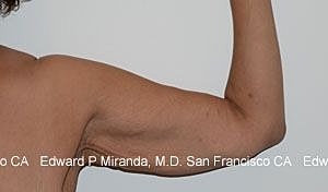 Arm Lift Before & After