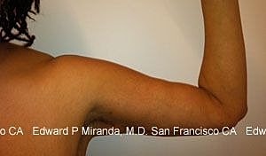 Arm Lift Before & After