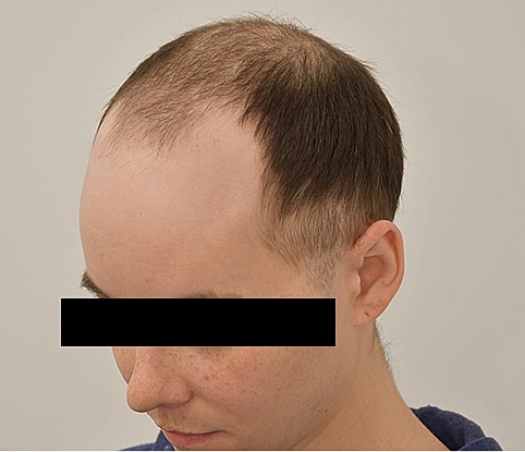 Gender Affirming Hair Before & After