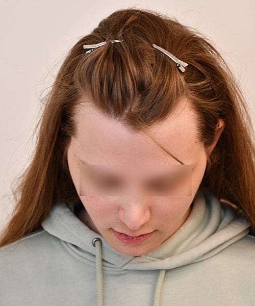 Person with hair clips looking downwards.