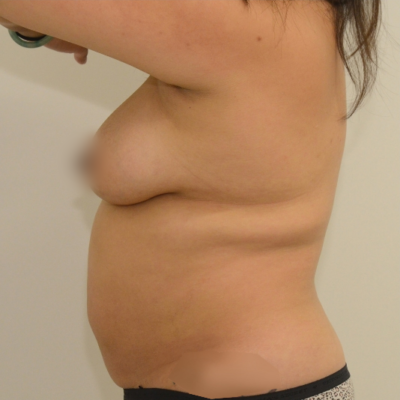 Liposuction Before & After