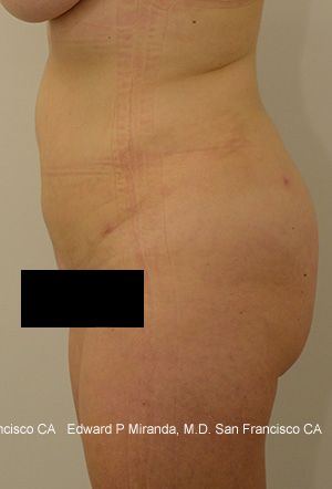 Liposuction Before & After