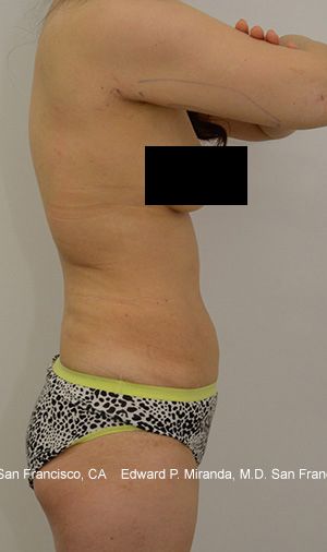Liposuction Before & After