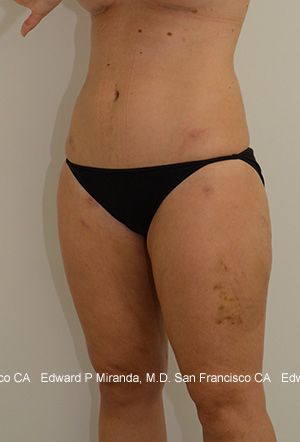 Liposuction Before & After